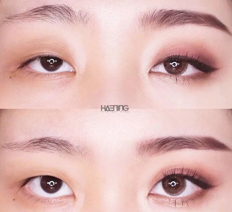 为什么三庭五眼眼距宽,眼距宽怎么改善做什么手术