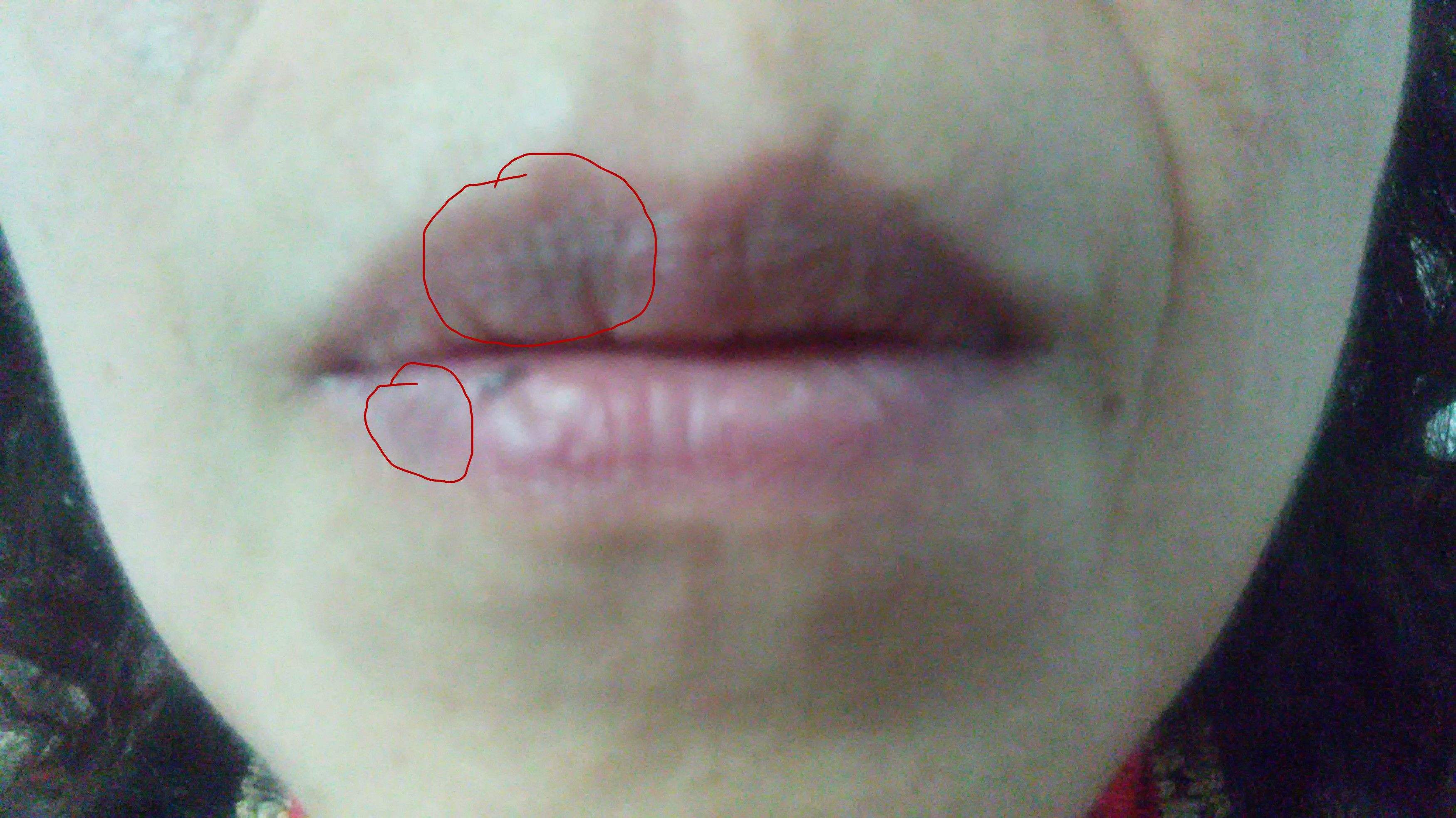 嘴唇黑痣有息肉,嘴巴上长痣了是肠道有息肉吗