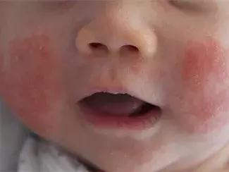 宝宝身上一大片的包是怎么回事,宝宝身上好多片包