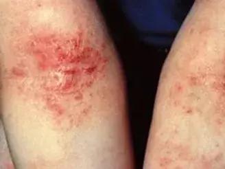 六个月宝宝湿疹皮肤破溃,宝宝起红疹破皮水泡