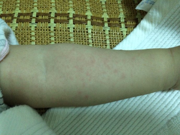 孩子夏天痱子的治疗方法,婴儿长痱子怎么快速消除止痒