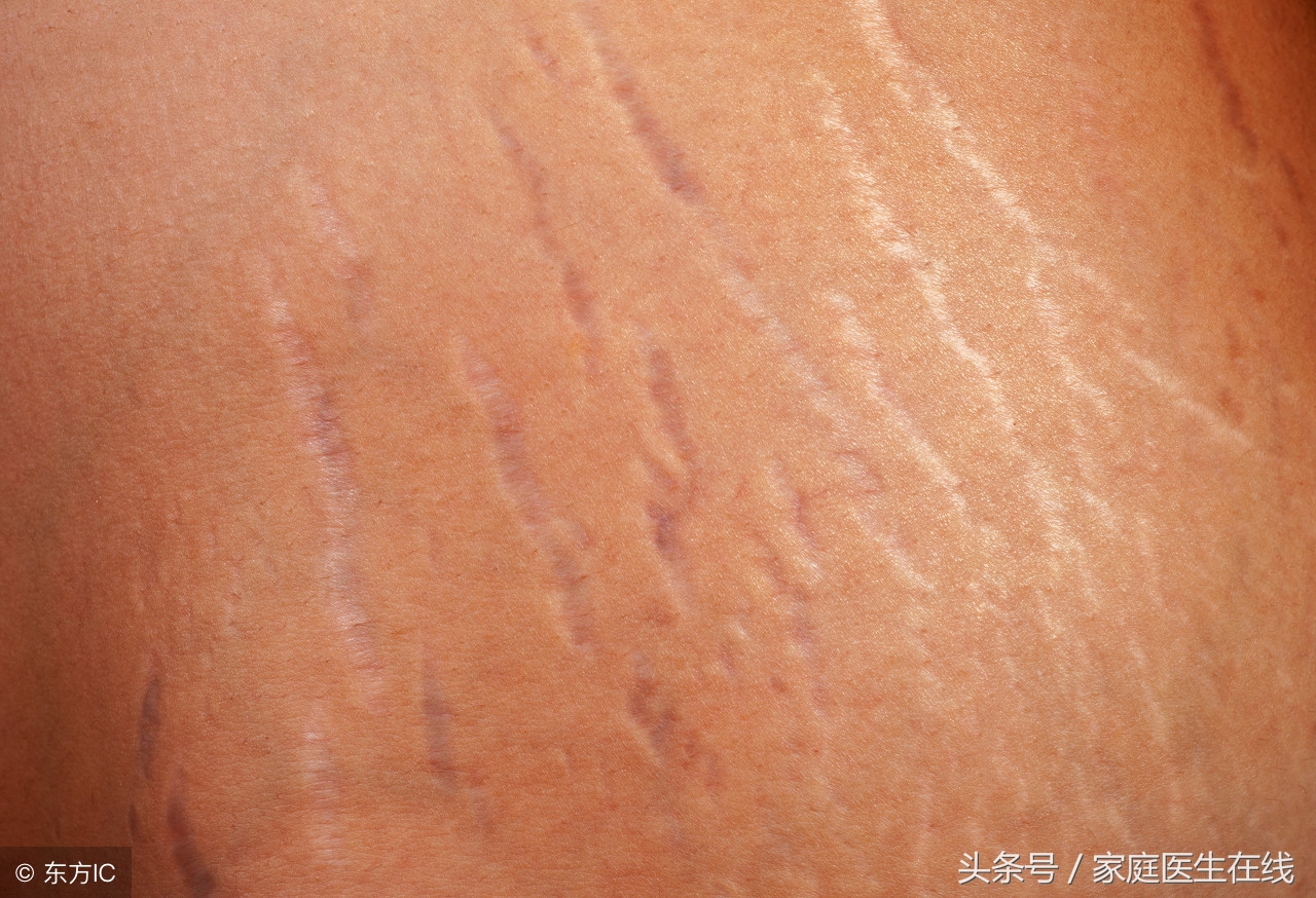 妊娠纹怎么消除推荐4个好方法,妊娠纹消除最快的方法是什么