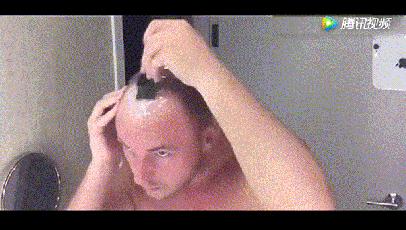 惨！90后集体脱发，发际线一去不复返！