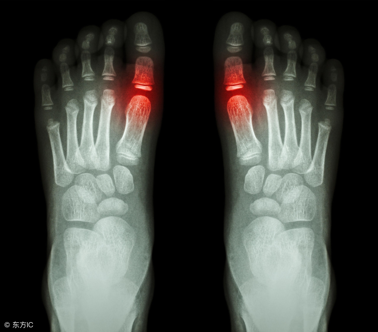 痛风发作后是否需非布司他降尿酸,痛风有哪些草药可以降低尿酸