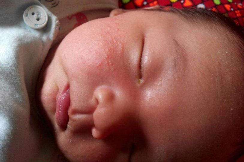 宝宝长痱子用花露水吗,宝宝长痱子用炉甘石反而更严重了