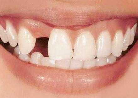 镶牙和种牙的区别种植牙的危害,种植牙的利与弊能镶牙就不要种牙