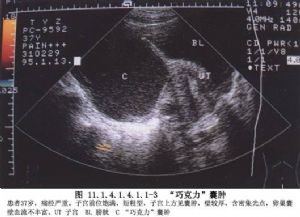 子宫内膜异位症的常见症状有哪些,谈谈子宫内膜异位症的症状有哪些