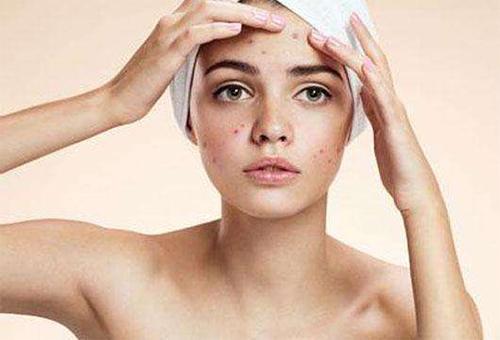 痘痘又硬又肿挤不出来,脸上有个痘痘挤掉了怎么肿了