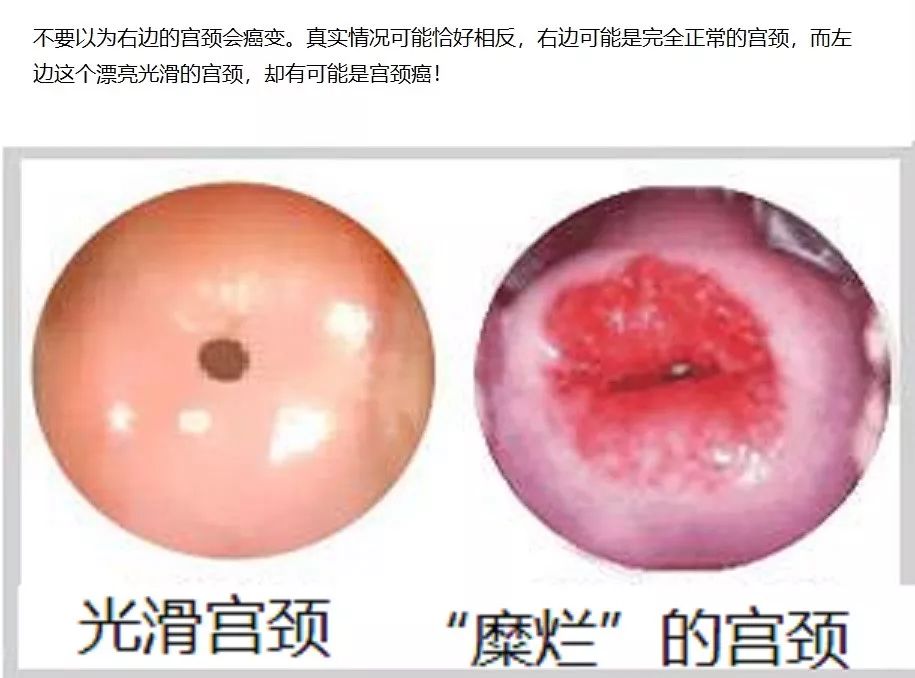 宫颈癌ia1期能治好吗,宫颈癌ia1期需要化疗吗