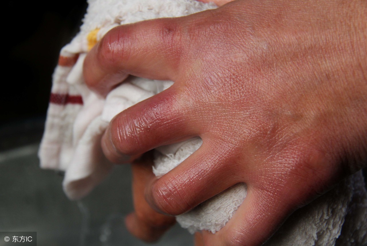 雷诺综合征的诊断与鉴别诊断,雷诺综合征怎么能诊断出来