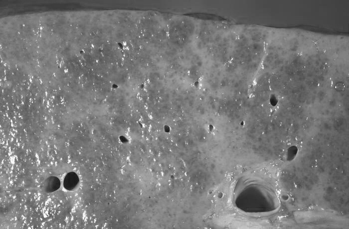 肝病专家能治好肝硬化吗,肝硬化是肝癌吗可以治愈吗