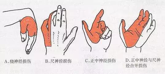 手麻痛不灵活，当心神经损伤！发现得越早，恢复得越好！