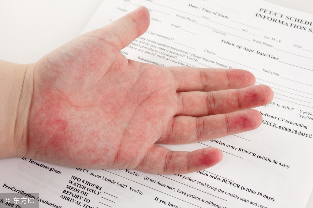 皮疹与湿疹区别在哪里？皮疹的饮食禁忌