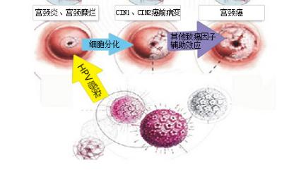 宫颈炎还会癌变?不用慌,一个营养方子,将引起炎症的病毒赶出去