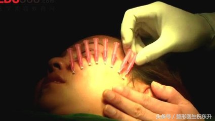 埋线提升多久能恢复好,真相来了拉皮手术潜在的风险