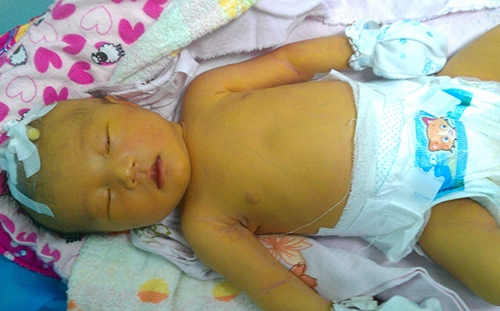 侯佩岑谈儿子溶血症前后,侯佩岑小儿子溶血症会如何