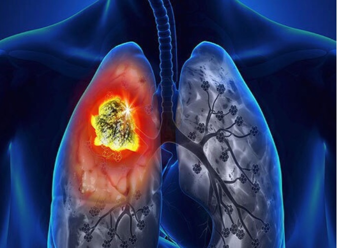 安罗替尼治小细胞肺癌吗,卡瑞利珠能治小细胞肺癌吗