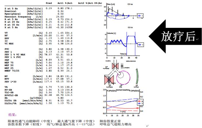 安罗替尼治小细胞肺癌吗,卡瑞利珠能治小细胞肺癌吗
