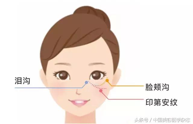 外眦韧带固定是什么手术,外眦悬吊固定疤痕多久恢复