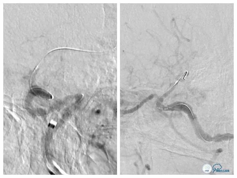 天坛医院住院日记,颈内动脉c5到c7段狭窄微创手术