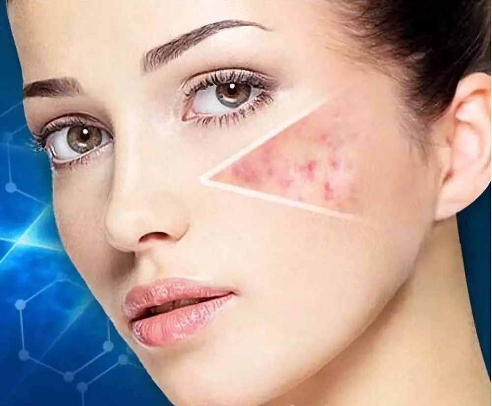 青春痘伤疤怎么修复,青春痘时间长疤痕修复的最佳方法