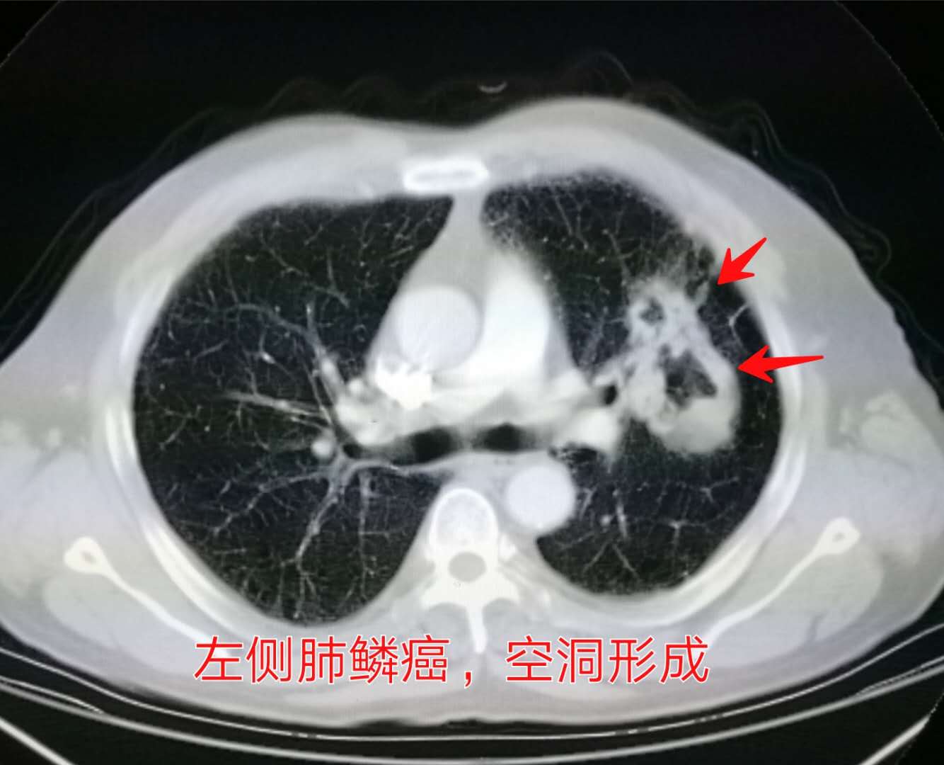 肺癌手术后胸腔内有碎肉怎么办,肺癌切除手术后有个空腔