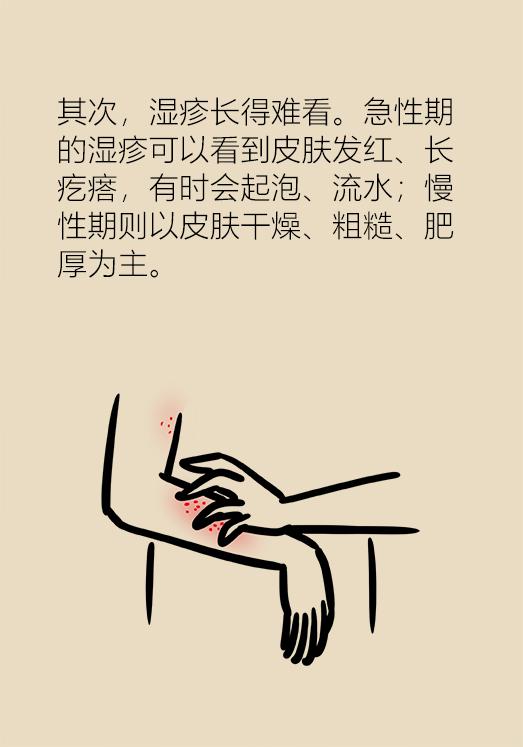 湿疹反复去医院挂哪个科,湿疹看西医反反复复怎么办