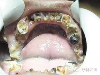 放疗能根治头颈部肿瘤吗,头颈部放疗前口腔处理