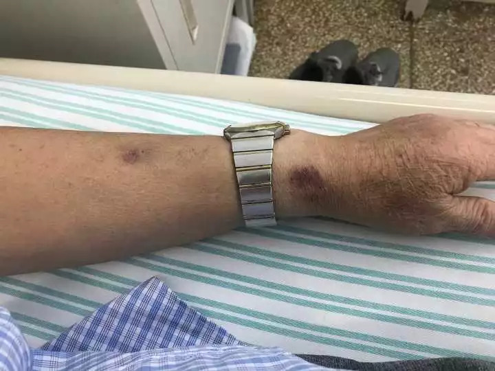 天呐！大伯吃掉上百支治皮炎的软膏，医生一问都懵了