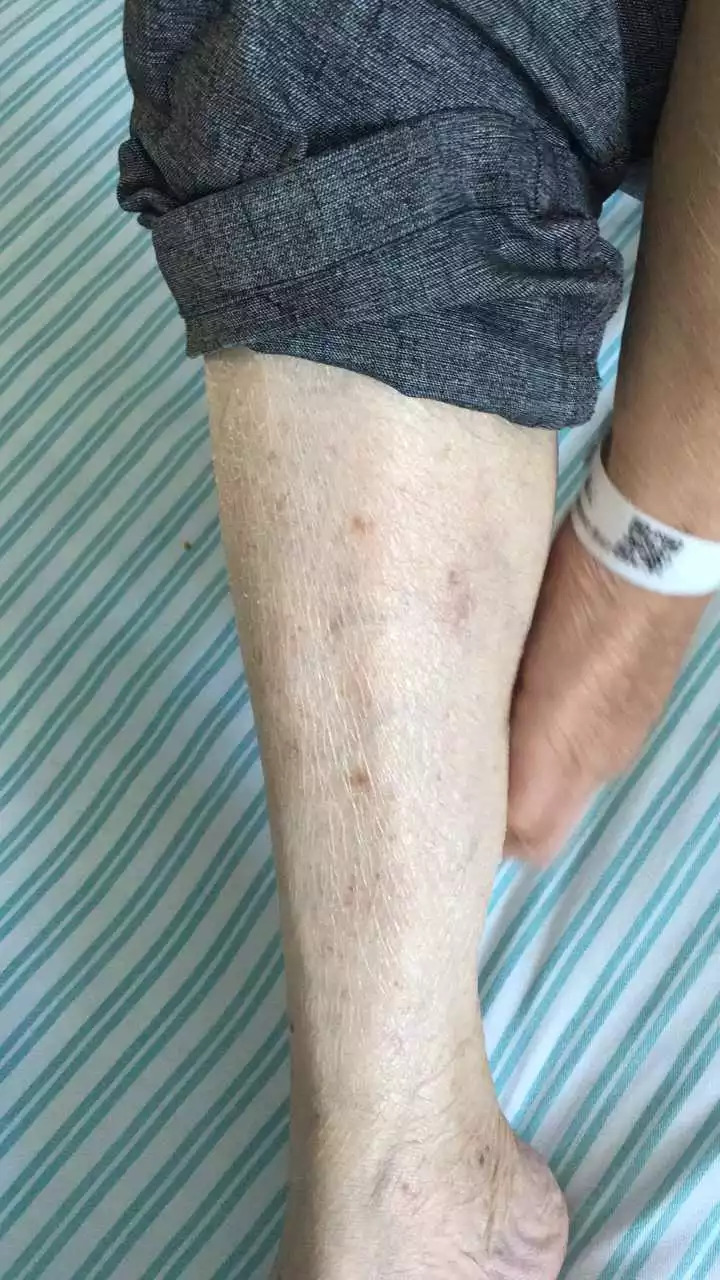 天呐！大爷吃掉上百支“皮炎平”软膏，医生一问都懵了