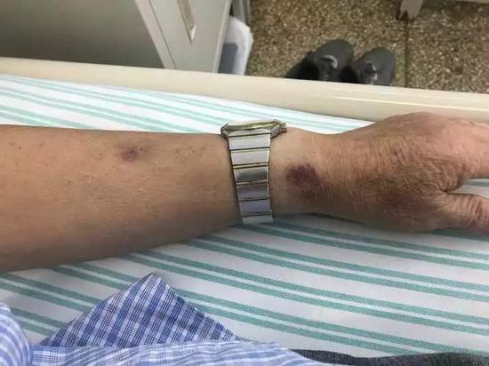 20岁小伙被诊断癌症,小伙25岁查出肝癌