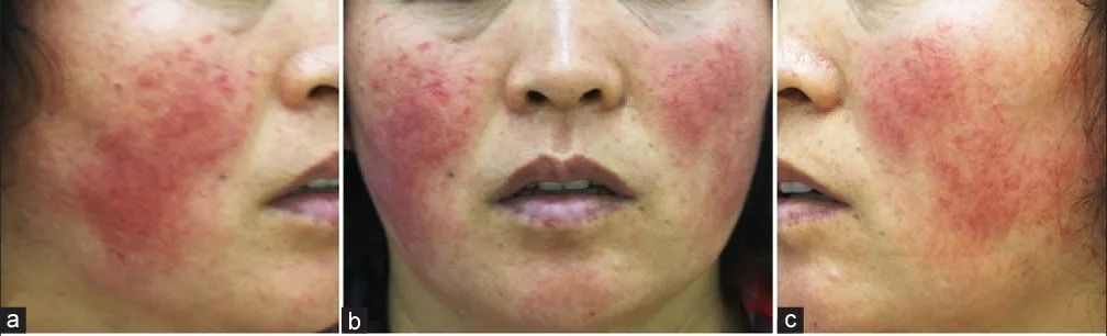 医生开的药膏会导致激素脸吗,用医生开的药膏会不会成为激素脸