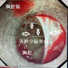 胸水为什么会抽不到,胸水抽了为什么还呼吸困难