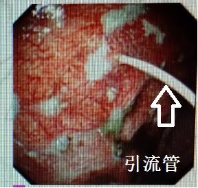 胸水为什么会抽不到,胸水抽了为什么还呼吸困难