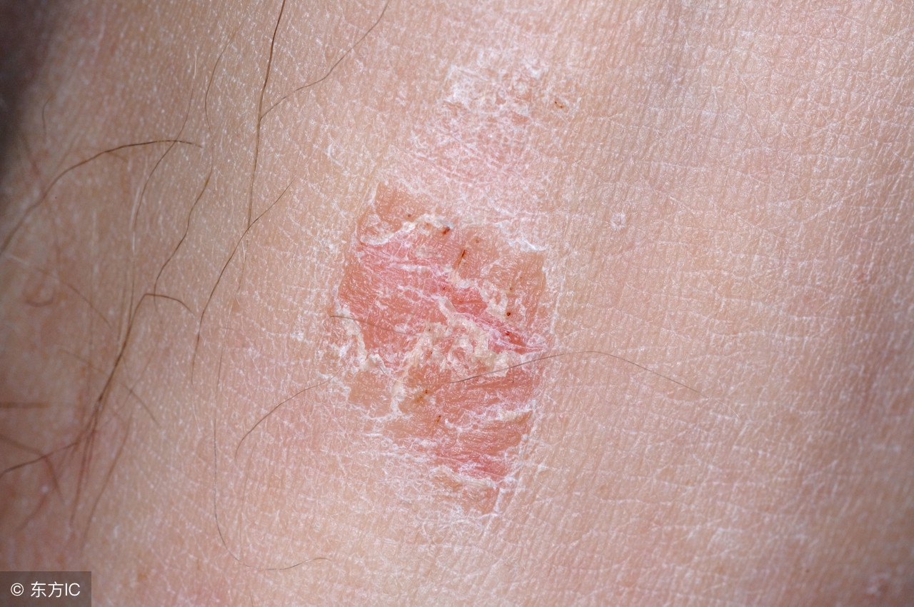 炉甘石洗剂的功效与作用,炉甘石洗剂用完了要洗掉吗