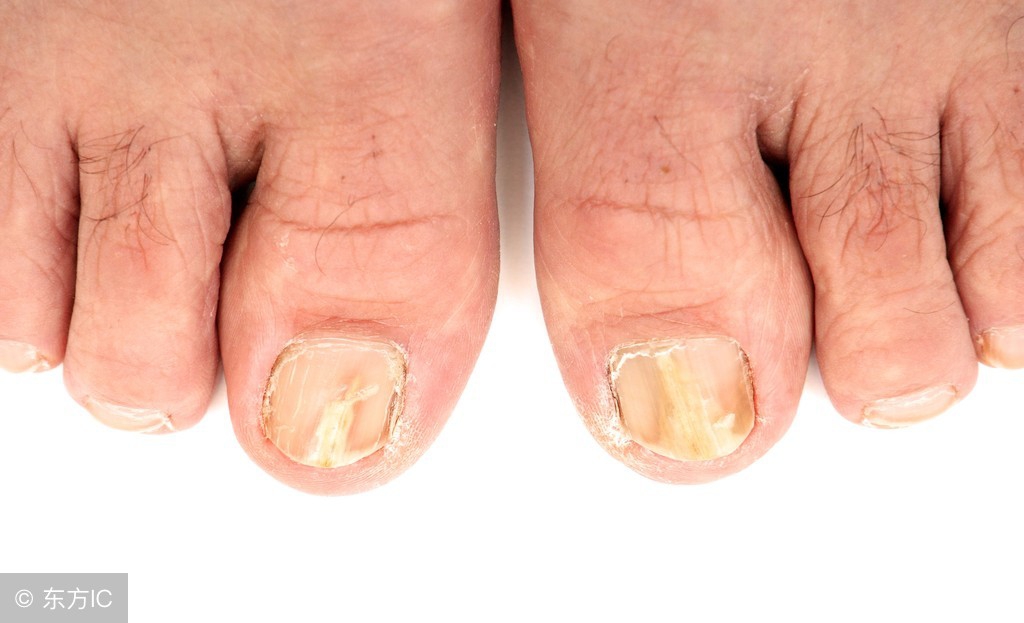 炉甘石洗剂的功效与作用,炉甘石洗剂用完了要洗掉吗