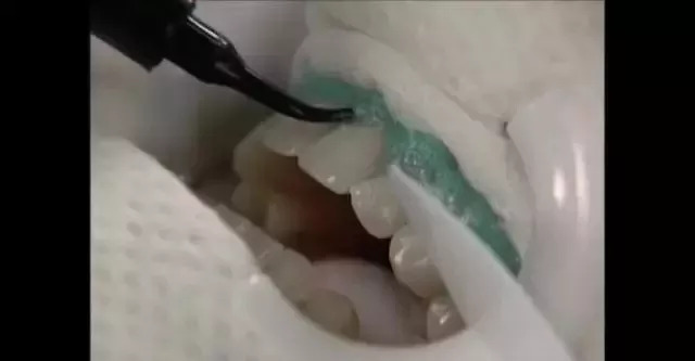 市面上冷光美牙仪真的有用吗,冷光美牙仪对牙齿伤害有多大