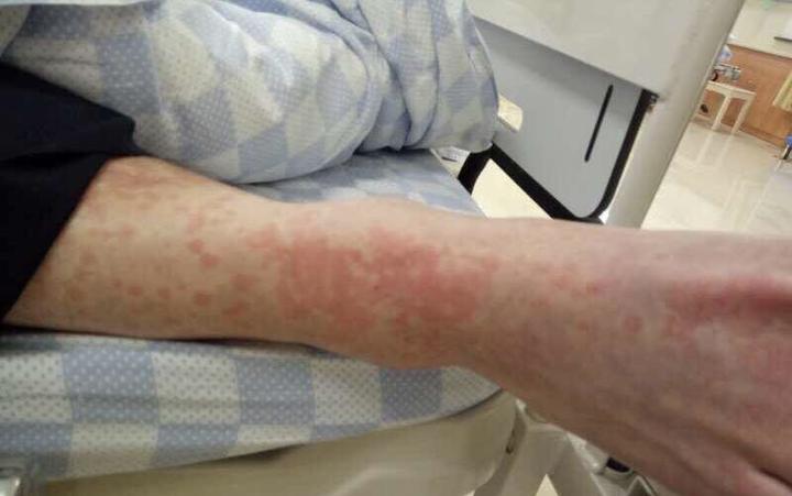 绍兴人被蜂刺身亡,成年人被毒蜂蜇了