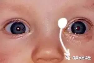 宝宝眼屎多是上火吗,白眼屎是寒气还是上火