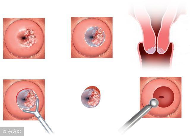 宫颈癌晚期脑膜转移后有什么症状,宫颈癌术后复发晚期死前症状