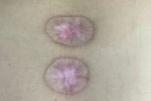 试遍了针灸艾灸拔罐，腰背疼痛的元凶竟是“肿瘤”