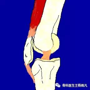 最新的人工膝关节使用寿命,膝关节使用说明