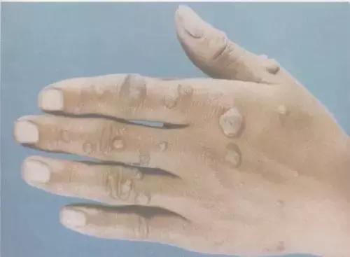 预防宫颈癌要打针,宫颈癌筛查52阳性可以打hpv疫苗吗