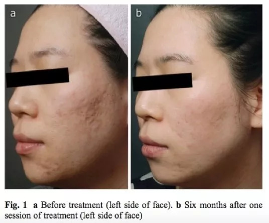 痘印特效药,斑点痘印的克星