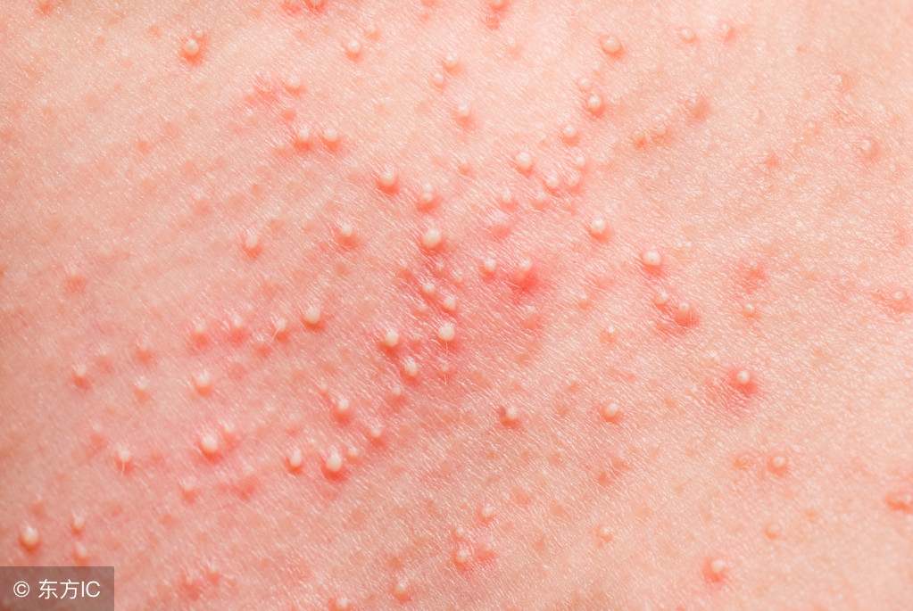 尖锐性湿疣治愈的标准是什么,彻底治愈尖锐性湿疣