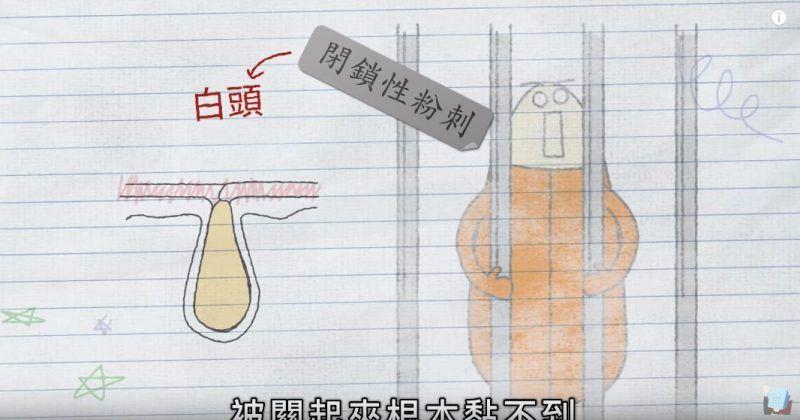 黑头贴吸出来的是粉刺还是黑头,去黑头闭口粉刺用黑头贴可以吗