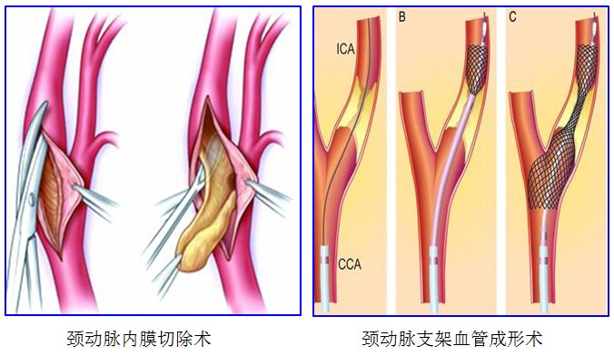 颈动脉脑血栓,颈动脉堵塞造成脑梗怎么预防