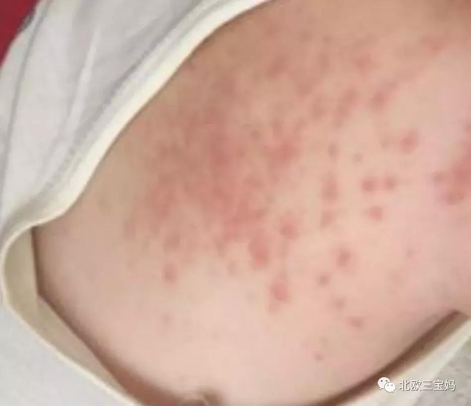 怎么分辨宝宝热疹湿疹荨麻疹,幼儿急疹和湿疹风疹有什么区别