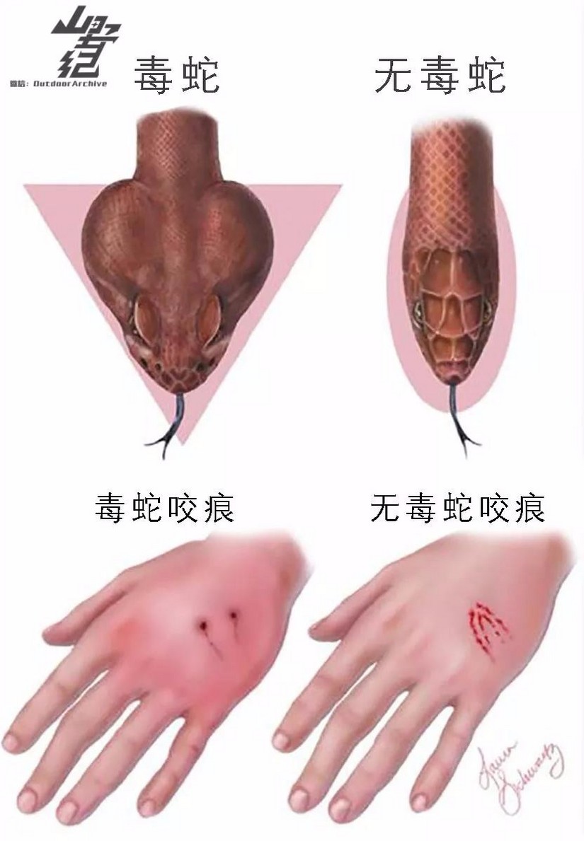 毒蛇咬伤需不需要截肢,被毒蛇咬后截肢会得昂髓炎吗