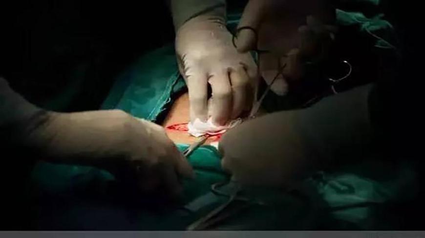 剖腹产一般伤口多久不怎么痛,剖腹产不痛是因为麻药多吗